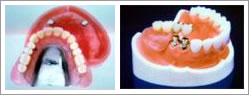 医療法人雄久会（新宿区・渋谷区の歯医者・歯科）の治療説明：磁石を使用した入れ歯